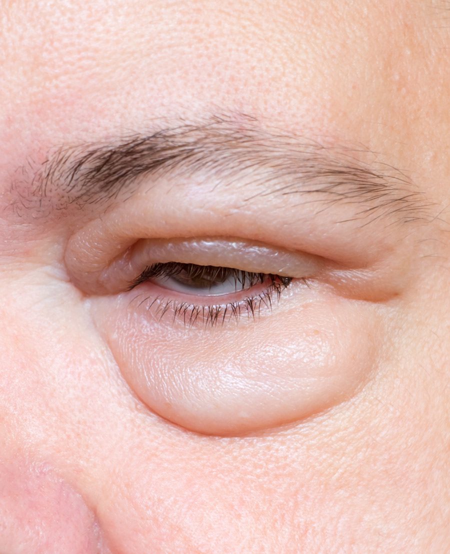 Swelling Around Eye Orbital Swellings Face Restoration Facial 